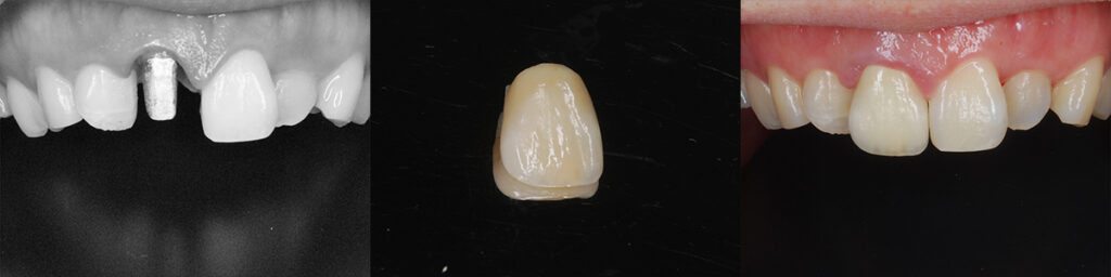 根管治療が終わり根管内に製作した金属ポストを固定し自然感のあるジルコニアセラミック冠で最終修復
