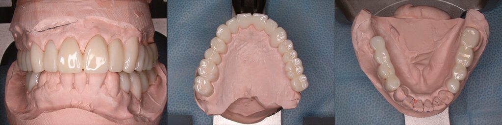 full mouth reconstruction-provisional restration on articulator