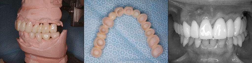 full mouth reconstruction-provisional restration   on teeth