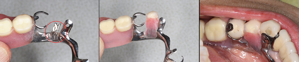金属の精密な義歯に欠損となった臼歯部分をスポット溶接を用いて修繕