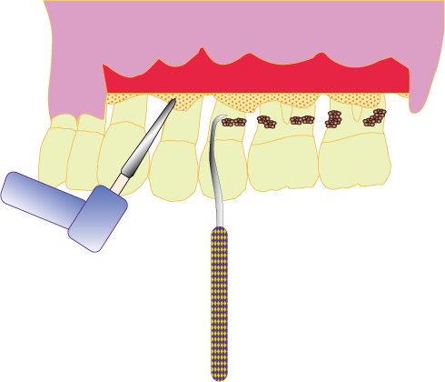 フラップオペレーション　歯肉剥離掻把術