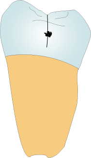 歯冠隣接面（隙間面）にできるむし歯はエナメル質のヒビが起点になります。
