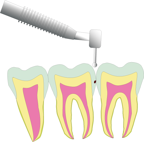隣接面カリエスの治療