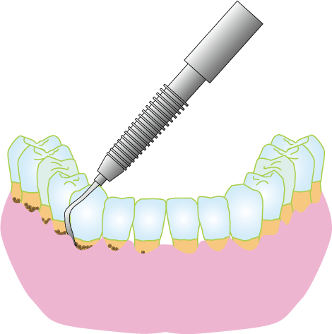 エアースケーラーによる歯石除去